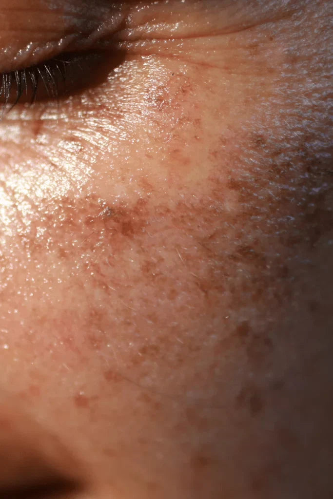 ✨ Manchas en la cara: por qué aparecen (antes de lo que crees) y cómo prevenirlas este verano
