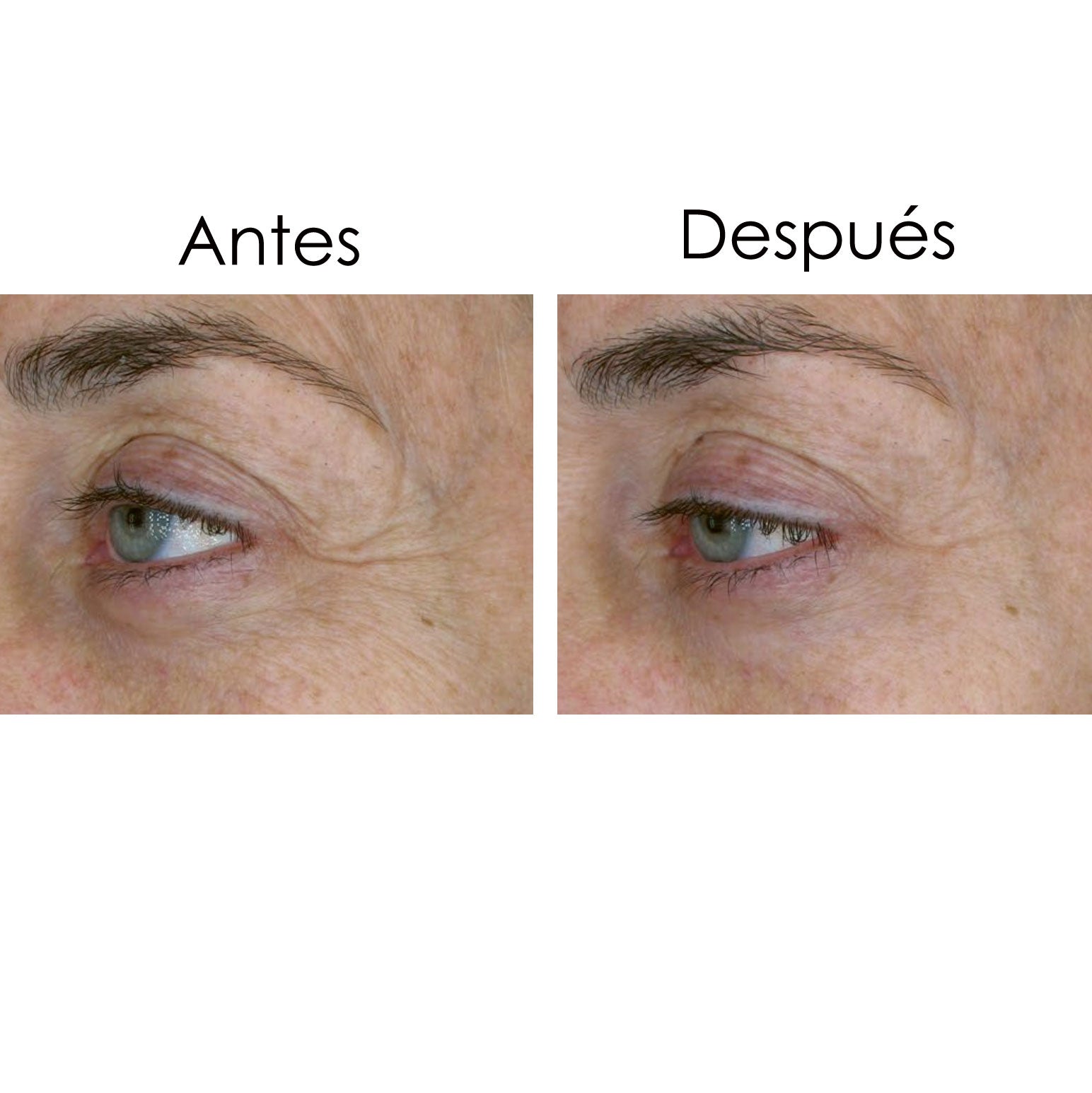 Resultados visibles tras aplicar el contorno de ojos y el sérum con Vin-up Lift, la alternativa natural al bótox. Reducción de las arrugas y patas de gallo.